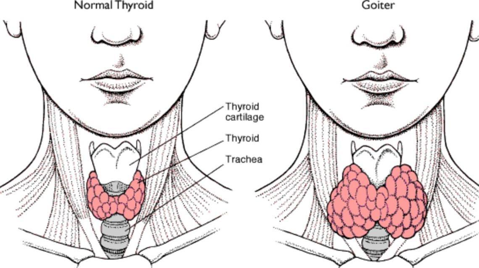 Увеличился узел щитовидной железы. Узловой эндемический зоб. Узловой зоб щитовидной железы. Диффузный эндемический зоб. Струма щитовидной железы.