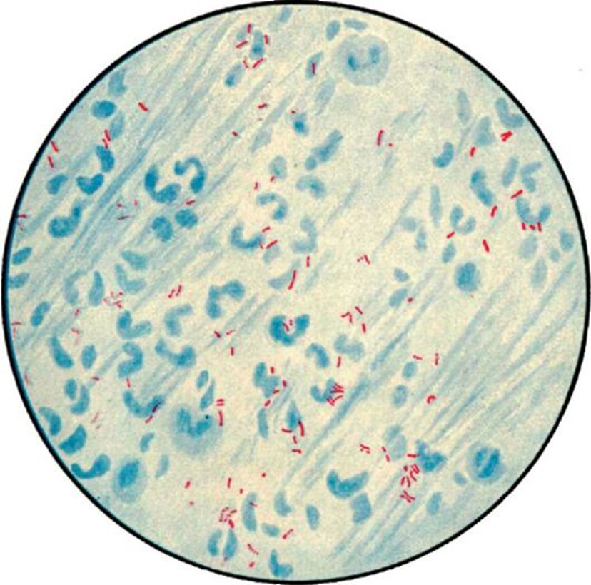 Микобактерии туберкулеза микроскопия мокроты. Микобактерия туберкулеза по Цилю Нильсену. Микобактерии туберкулеза микроскопия по Цилю Нильсену. Окрашивание микобактерий туберкулеза по Цилю Нильсену.