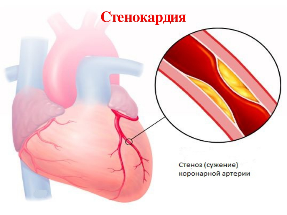 Ишемия сосудов симптомы. ИБС стенокардия инфаркт миокарда. Симптомы ИБС инфаркт миокарда. Инфаркт миокарда окклюзия артерий. Атеросклероз венечных артерий сердца.
