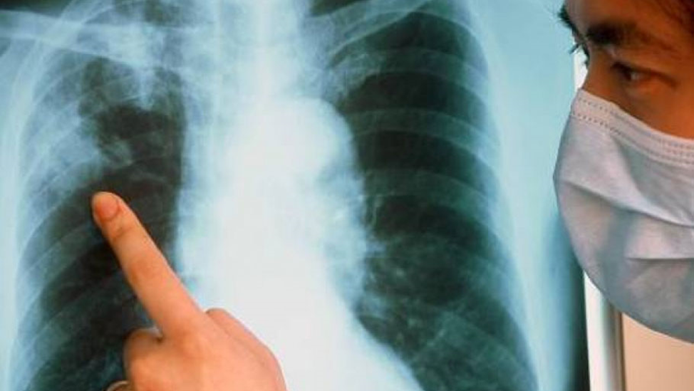 Симптомы туберкулеза на ранней стадии у взрослых: когда нужно обследовать своё здоровье