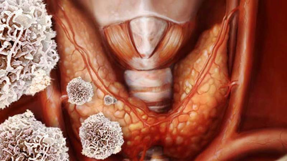 Аутоиммунный зоб: особенности течения загадочной болезни