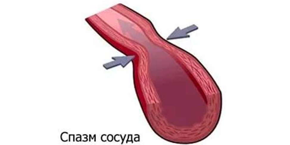 Спазм венечных сосудов. Вазоспазм коронарных артерий. Рефлекторный спазм поврежденных сосудов. Коронарный ангиоспазм. Почему спазм сосудов