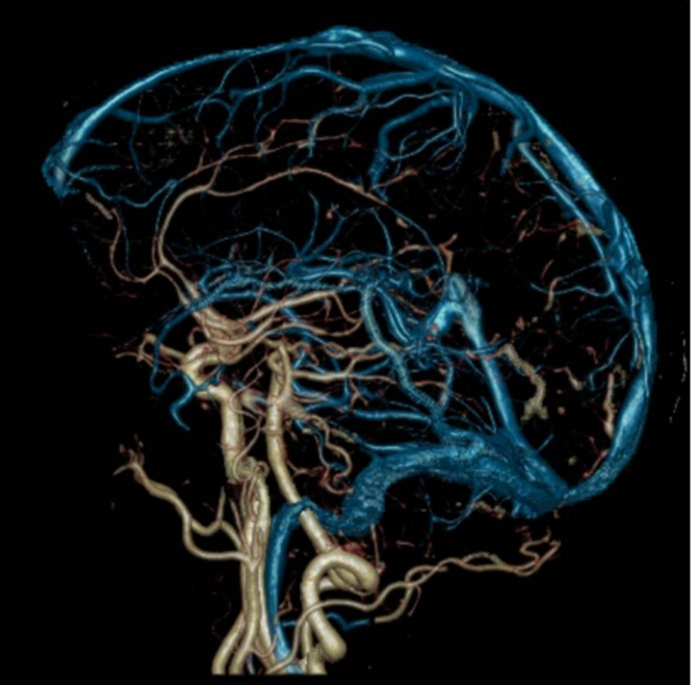 Ангиография сосудов головного мозга : простой и эффективный метод диагностики цереброваскулярных заболеваний