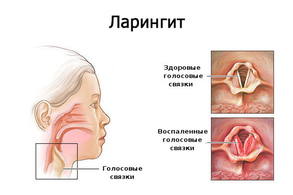 Лечение голосовых связок