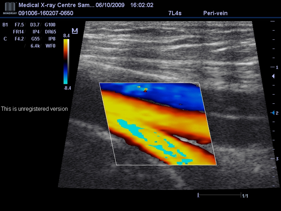Доплер артерий. Ультразвуковая допплерография сосудов нижних конечностей. Допплеровское сканирование сосудов нижних конечностей. Ультразвуковое допплеровское картирование. УЗИ исследование вен нижних конечностей.