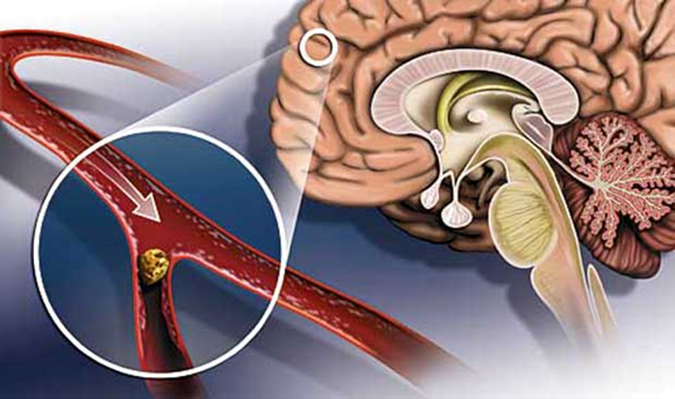 Признаки атеросклероза сосудов головы и шеи: что делать, если холестериновые бляшки «поселились» в мозгу