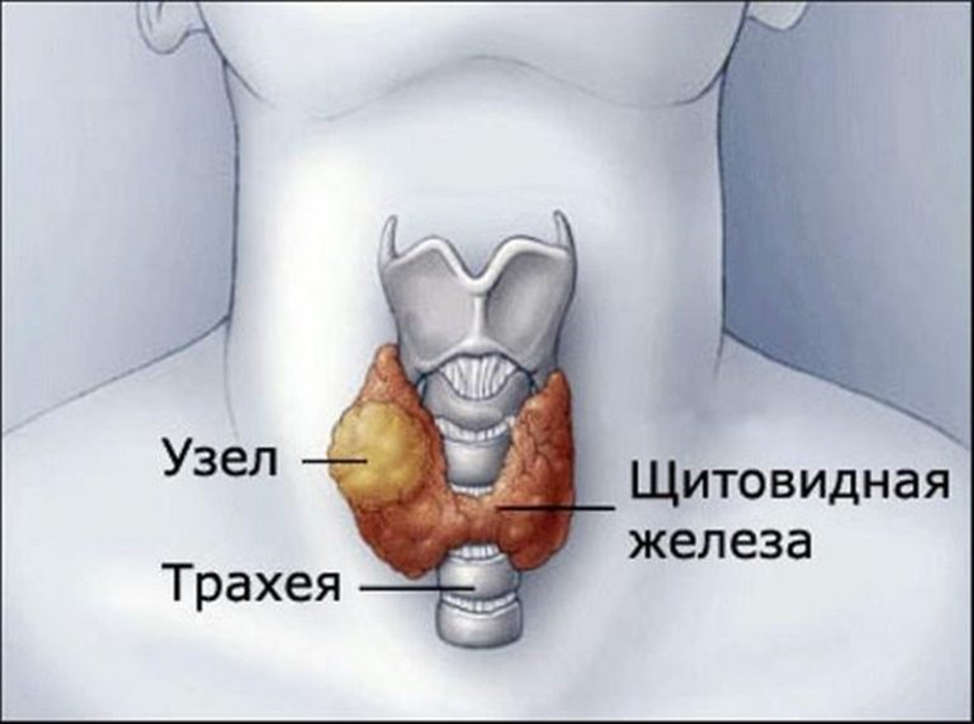 Чем опасен узелок на щитовидной железе: почему нужно бежать к врачу