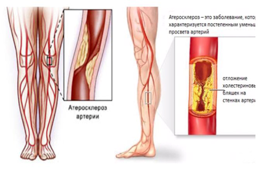 Нарушение кровообращения в сосудах. Облитерирующий атеросклероз сосудов ног. Макроангиопатия сосудов нижних конечностей. Облитерирующий атеросклероз сосудов верхних конечностей. Облитерирующий атеросклероз сосудов нижней конечности 2,.