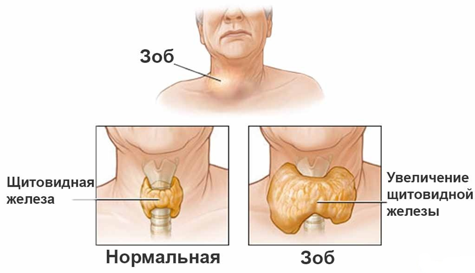 Клиническая картина эндемического зоба