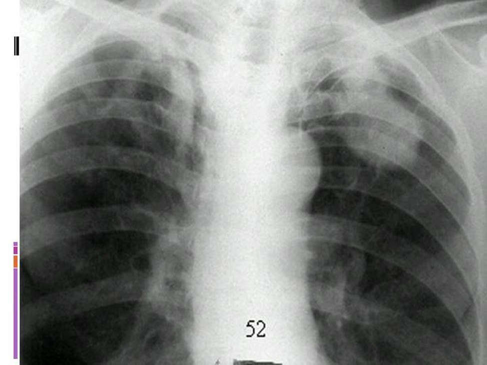 Туберкулома рентген. Туберкулема легкого рентгенограмма. Туберкулема туберкулез легких рентген. Туберкулома легкого рентген.