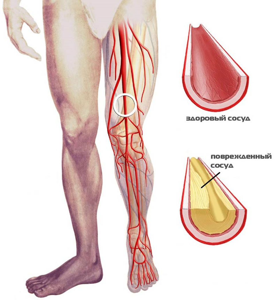 Тромбофлебит артерий. Облитерирующий атеросклероз сосудов конечностей. Облитерирующий атеросклероз вен нижних конечностей. Облитерирующий атеросклероз сосудов нижних. Облитерирующий атеросклероз артерий нижних конечностей ноги.